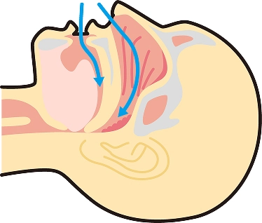 睡眠時無呼吸症候群(SAS)とは